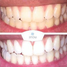 Load image into Gallery viewer, Special Offer - SNOW Teeth Whitening™ System