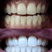 Load image into Gallery viewer, Floyd Mayweather's Snow Teeth Whitening™ At-Home System [All-in-One Kit]

