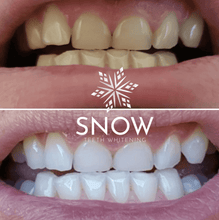 Load image into Gallery viewer, GRONK's Snow® Teeth Whitening At-Home System [All-in-One Kit]
