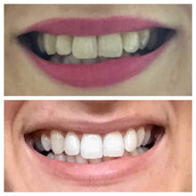 Load image into Gallery viewer, Snow® Teeth Whitening At-Home System [FabFitFun Exclusive]
